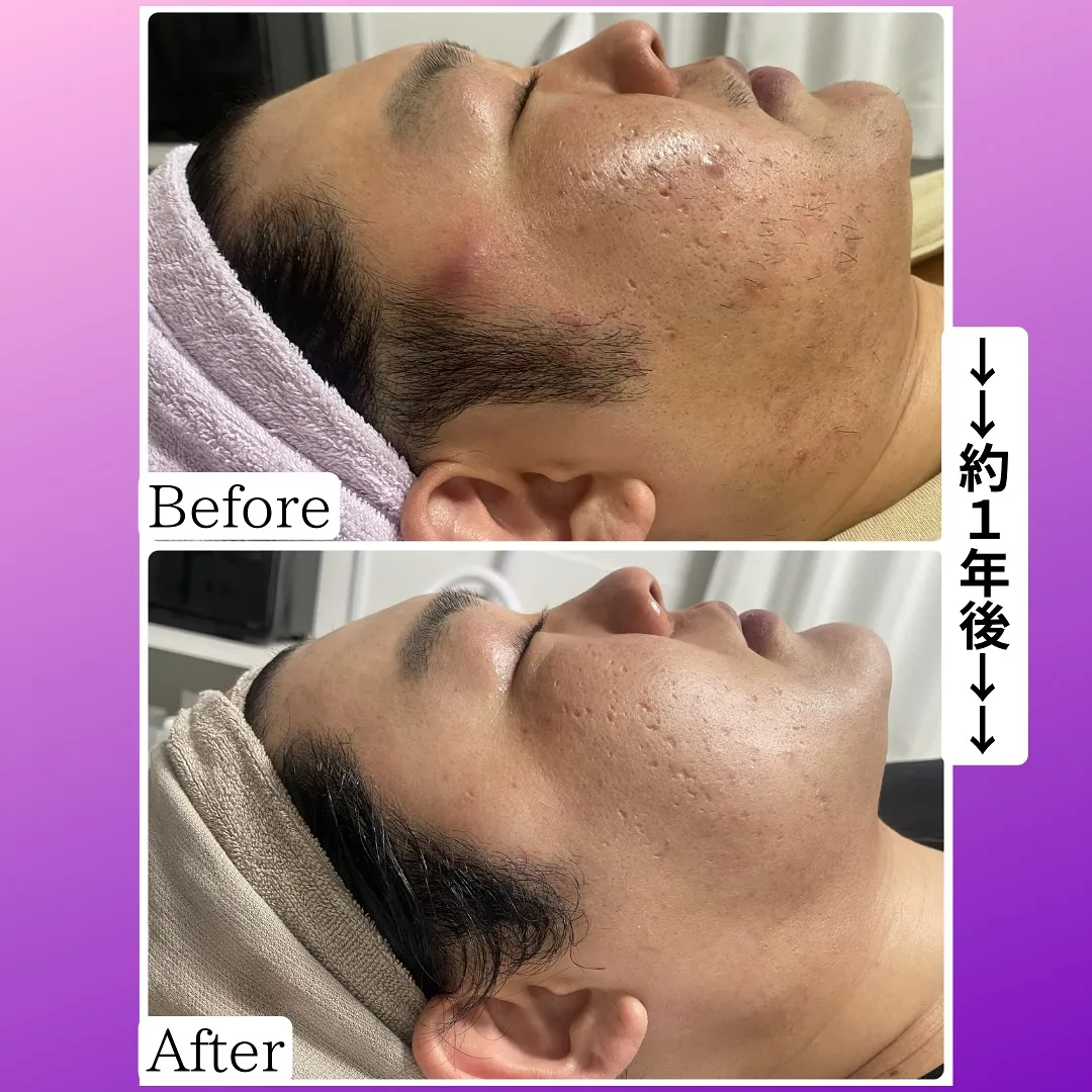 先日嬉しい口コミを頂きました、30代男性の症例のお写真☆