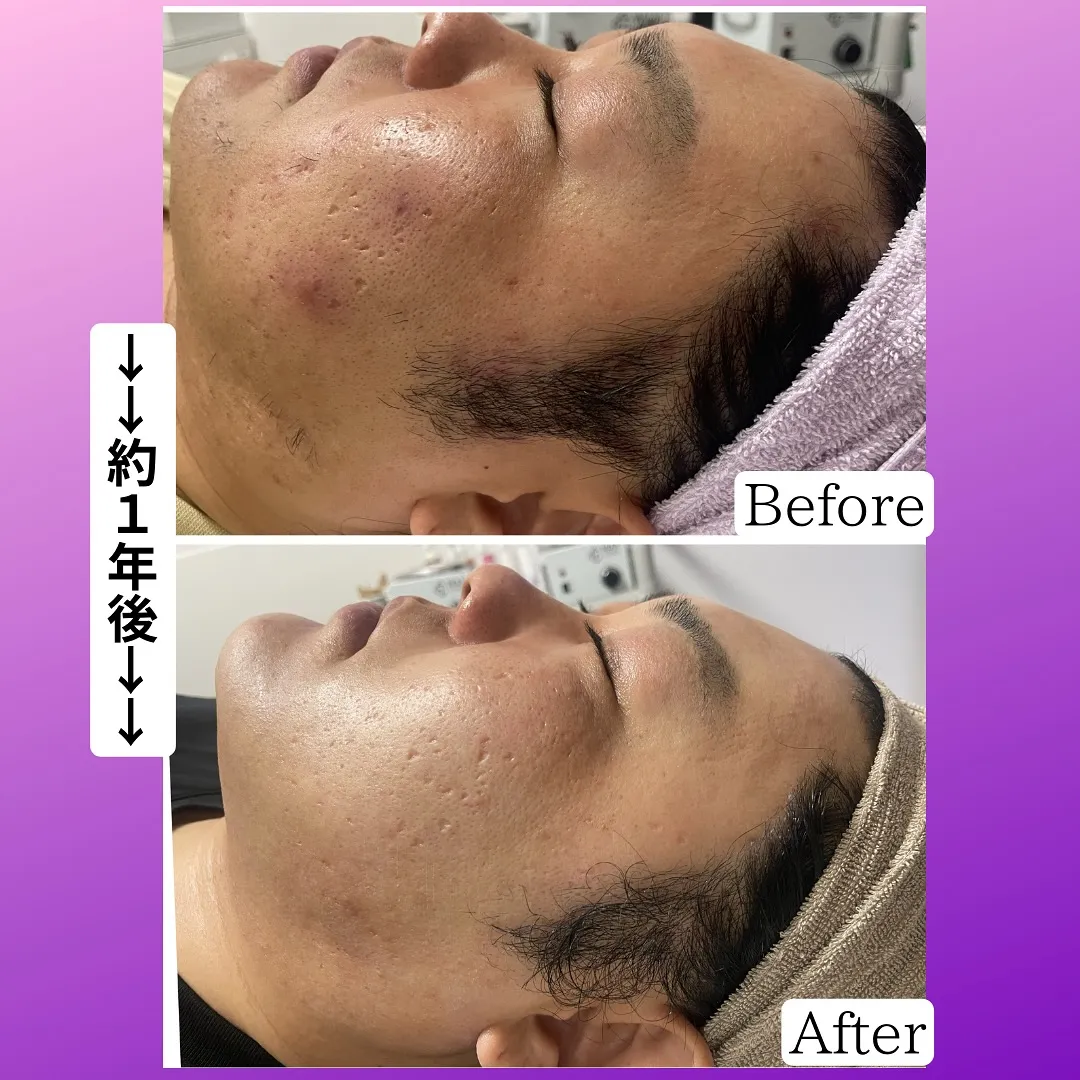 先日嬉しい口コミを頂きました、30代男性の症例のお写真☆