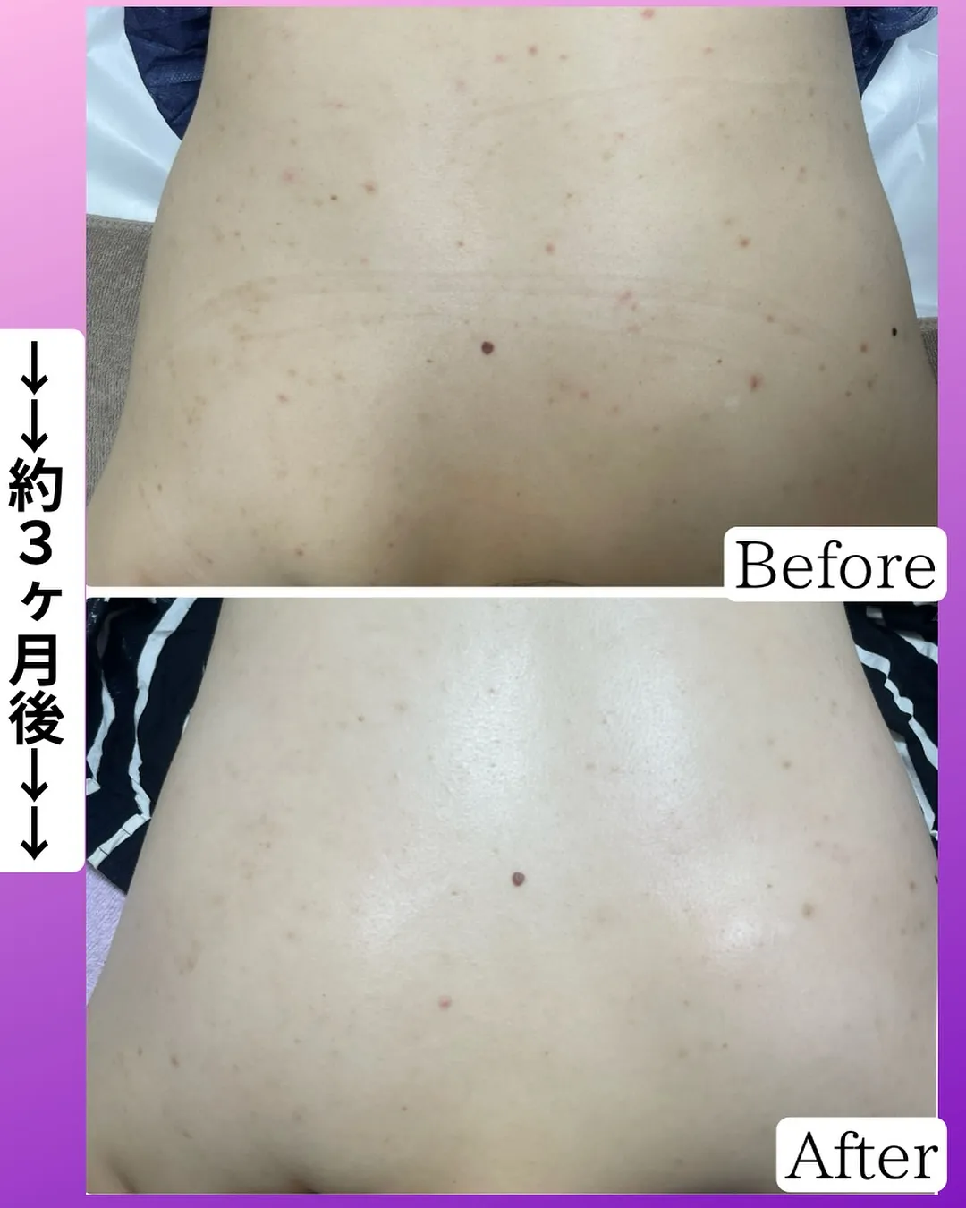 お背中のクリスティーナトリートメントでお通いのお客様より嬉し...